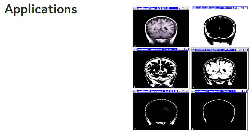 Image Segmentation in Medical Imaging